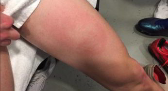 Napoli, Fabian mostra la gamba: “è questo il fallo di mano…”