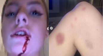 L’attaccante del Manchester United massacra di botte la fidanzata, lei pubblica le foto: “Guardate cosa mi fa”